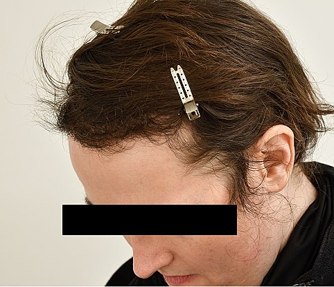 MTF Hair Gallery Before & After