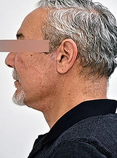 Facelift Before & After