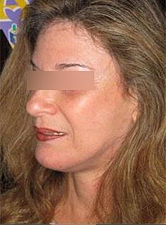 Facelift Before & After