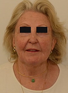 Facelift Before & After