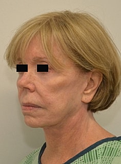 Facelift Before & After