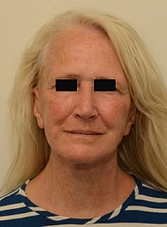 Facelift Before & After