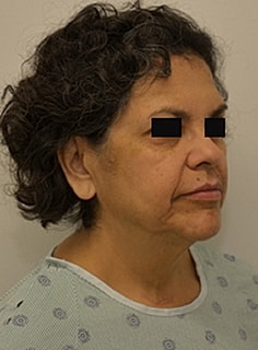 Facelift Before & After