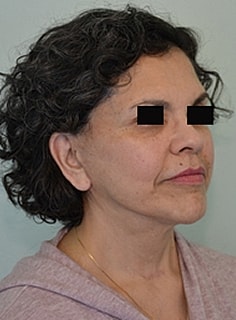 Facelift Before & After