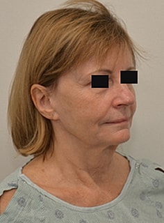 Facelift Before & After