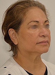 Facelift Before & After