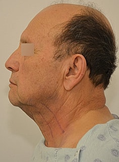 Facelift Before & After