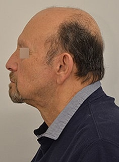 Facelift Before & After
