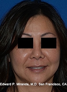 Facelift Before & After