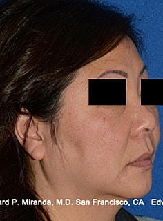 Facelift Before & After