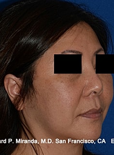 Facelift Before & After