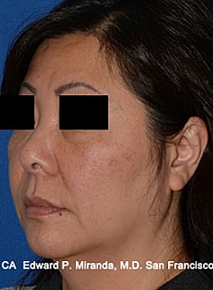 Facelift Before & After