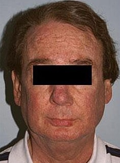 Facelift Before & After