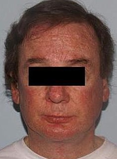 Facelift Before & After