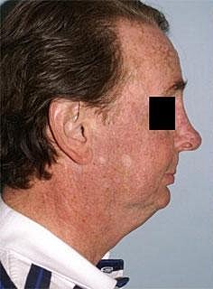 Facelift Before & After