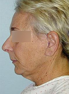 Facelift Before & After