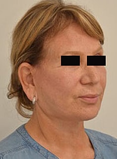 Facelift Before & After