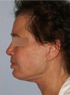 Facelift Before & After
