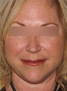 Facelift Before & After