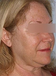 Facelift Before & After