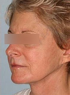 Facelift Before & After