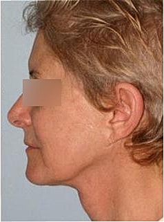Facelift Before & After