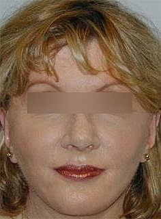 Facelift Before & After