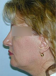 Facelift Before & After