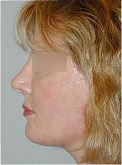 Facelift Before & After