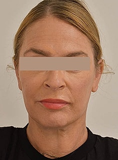 Facelift Before & After