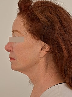 Facelift Before & After