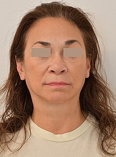 Facelift Before & After