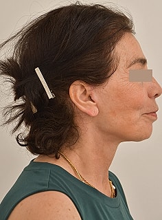 Facelift Before & After