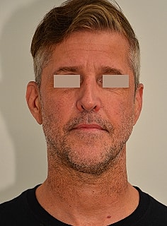 Facelift Before & After