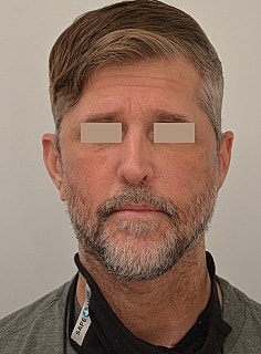 Facelift Before & After