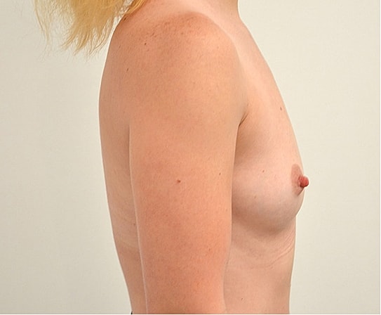 Breast Augmentation Before & After