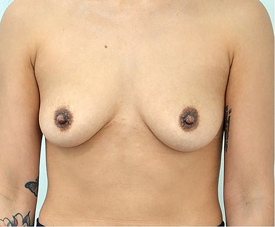 Breast Augmentation Before & After