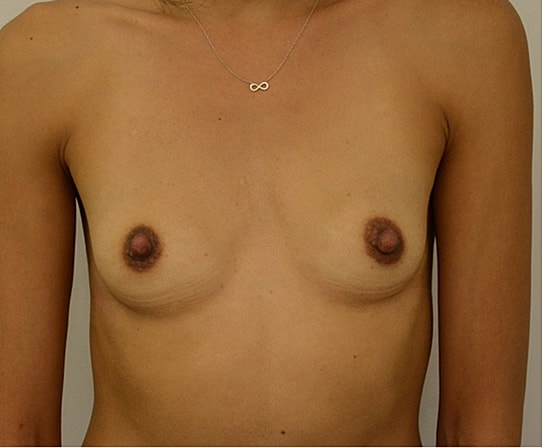 Breast Augmentation Before & After