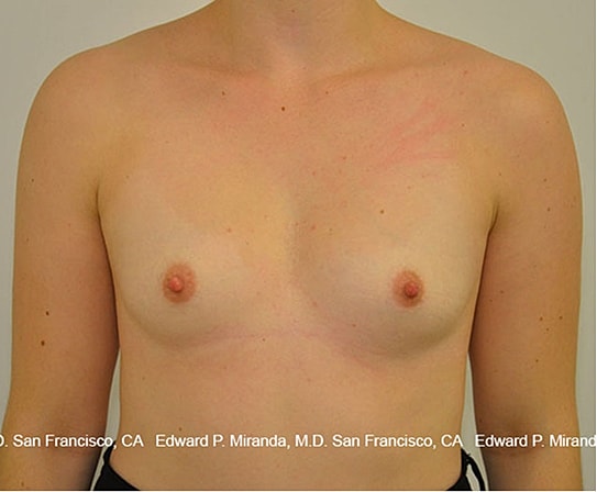 Breast Augmentation Before & After