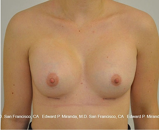 Breast Augmentation Before & After