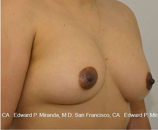 Breast Augmentation Before & After