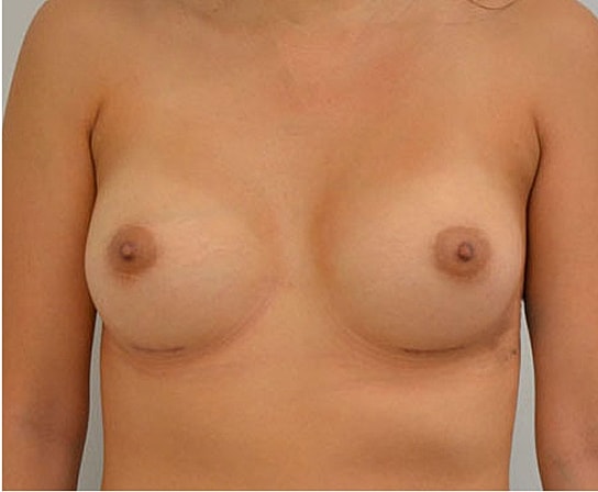 Breast Augmentation Before & After