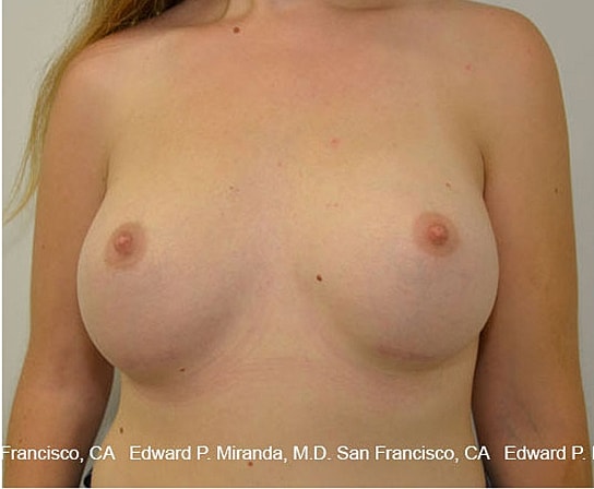 Breast Augmentation Before & After