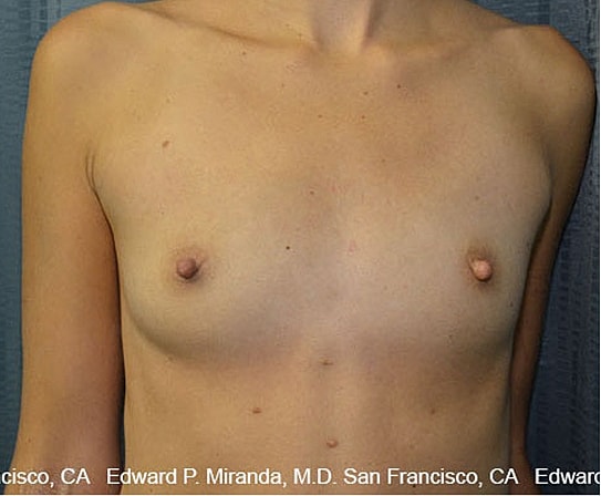 Breast Augmentation Before & After