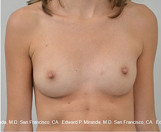 Breast Augmentation Before & After