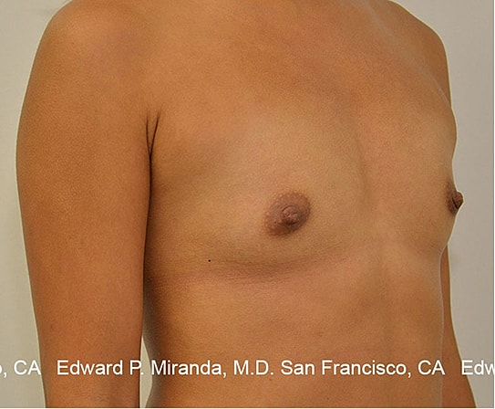 Breast Augmentation Before & After
