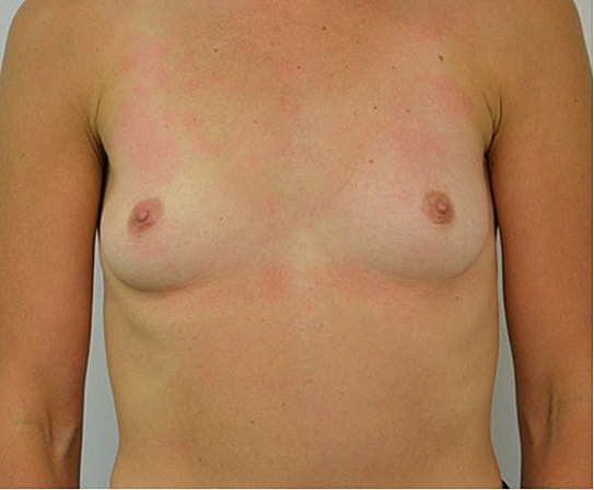 Breast Augmentation Before & After