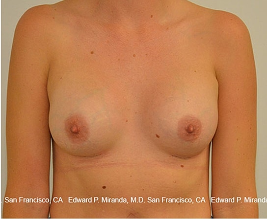 Breast Augmentation Before & After