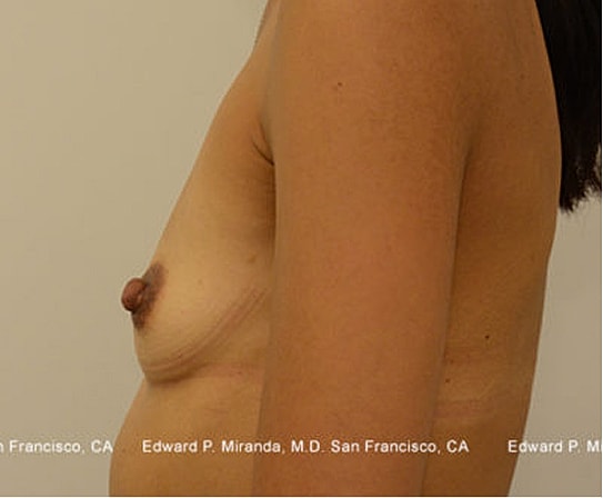 Breast Augmentation Before & After