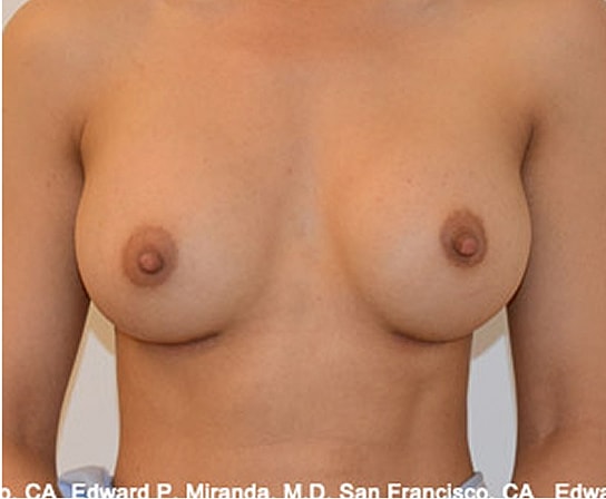 Breast Augmentation Before & After